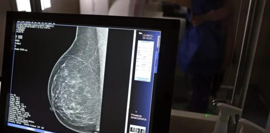 Outubro Rosa: Diagnóstico precoce ganha reforço com mamografia a partir dos 40 anos