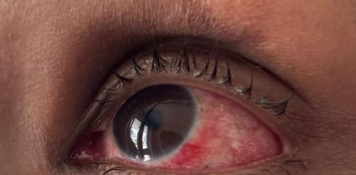 Especialistas da reda pública do DF alertam para cuidados com a conjuntivite